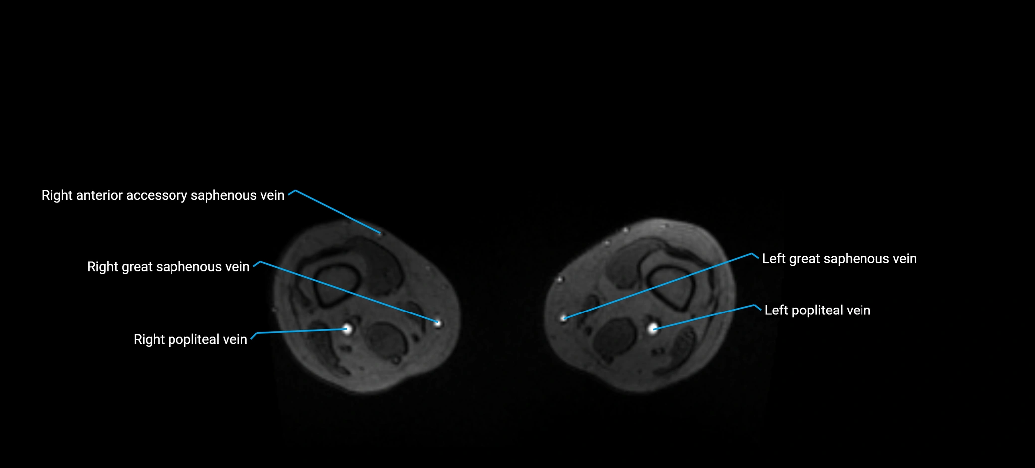 MRV abdomen pelvis & lower limb axial cross sectional anatomy labelled MRI image 342.webp